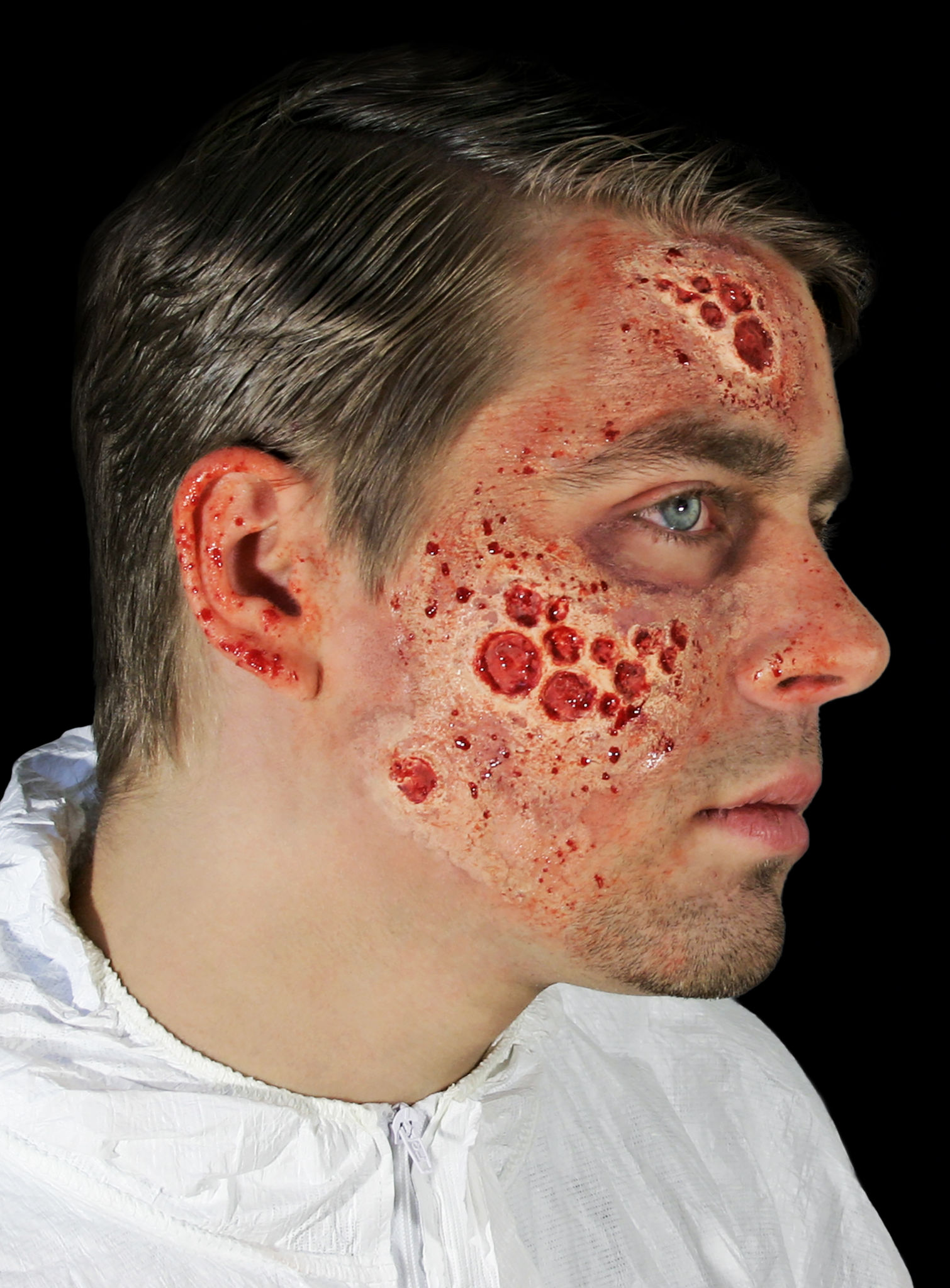 Strahlenbrand Wunden aus Latex